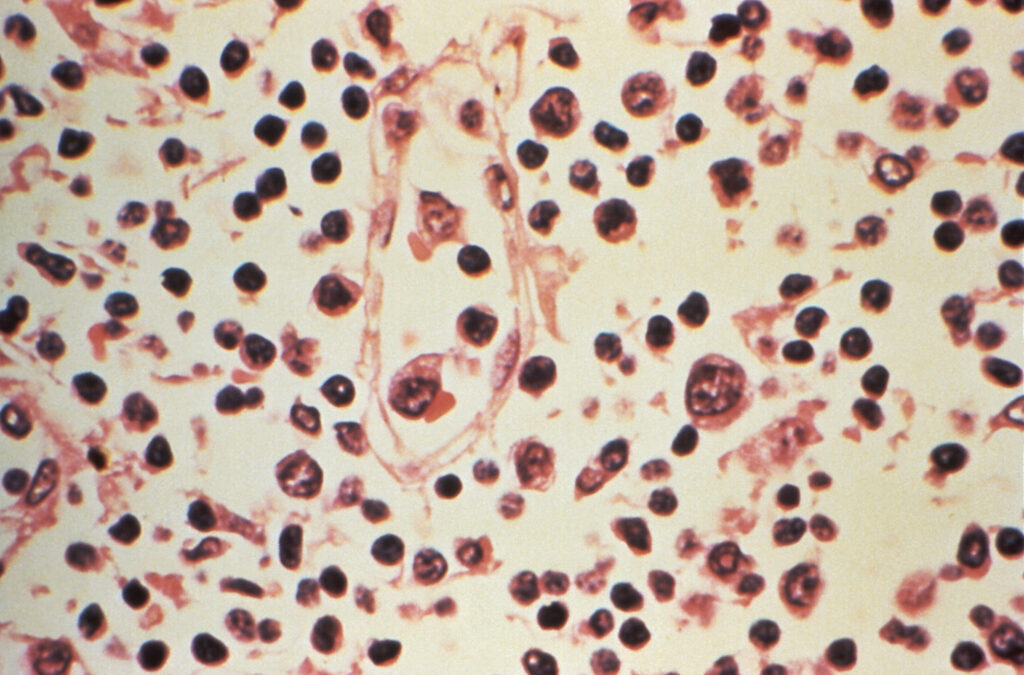 FILE PHOTO: Some of the cytoarchitectural features in a lymph node specimen extracted from a patient suspected of a Hantavirus illness
