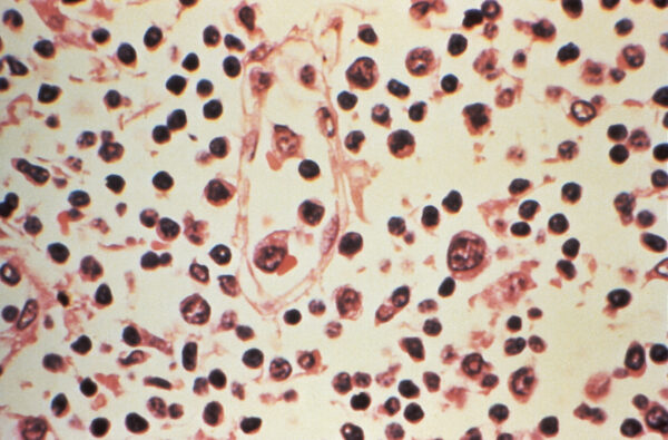 FILE PHOTO: Some of the cytoarchitectural features in a lymph node specimen extracted from a patient suspected of a Hantavirus illness