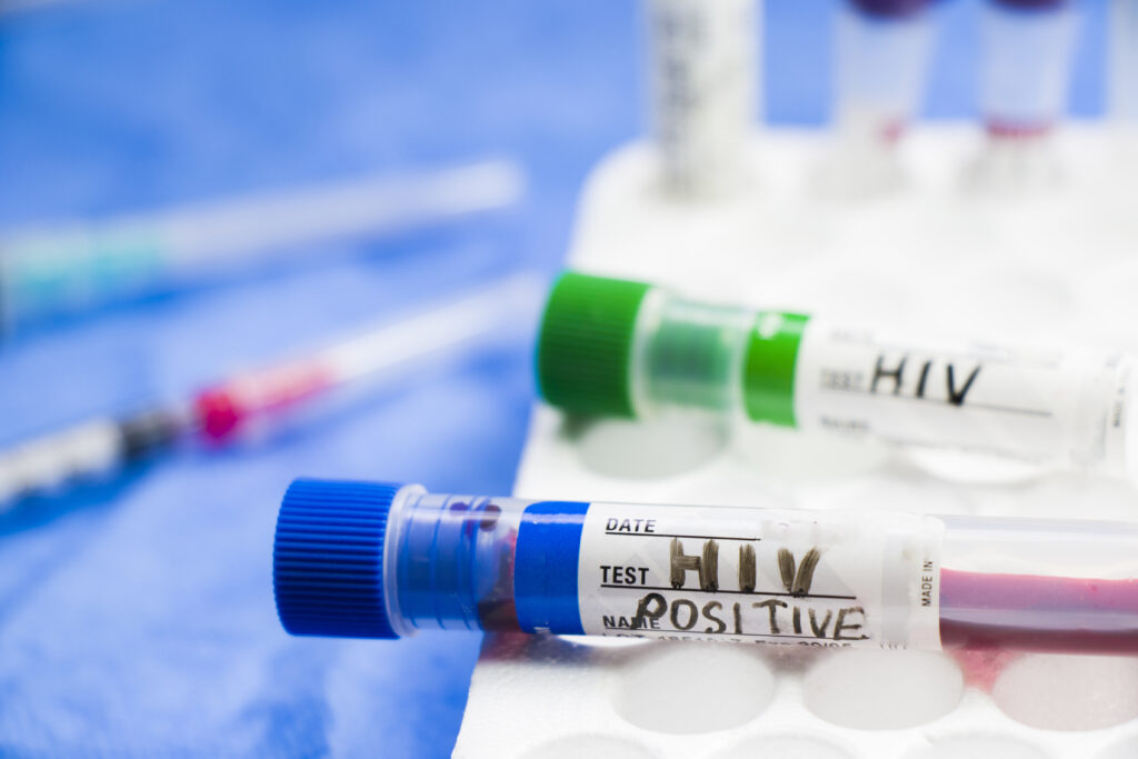 Selective focus of positive HIV blood specimen on test tube in the laboratory